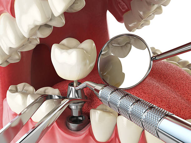 Best Same-Day Emergency Dental Services in Albion, IN